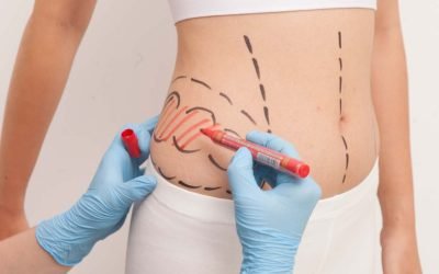 liposuction—yag-aldirma-2021-06-07_13-28-12-05739550383024574 liposuction---yag-aldirma-2021-06-07_13-28-12-05739550383024574